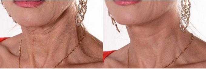 सौंदर्य-अजीब: क्यों गर्दन पर महिलाओं गोंद टेप
